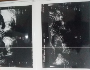 Need Answer From Gynea 