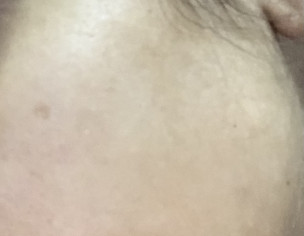 White Spots On Skin