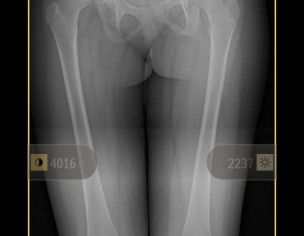 Hip Dysplasia