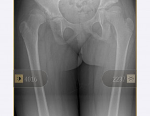 Hip Dysplasia