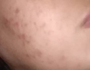 Skin Problem (melasma)