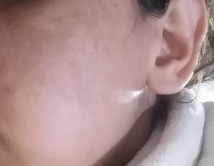Skin Problem (melasma)