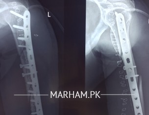 Feeling Severe Pain. 