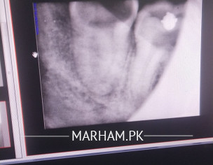 Wisdom Tooth Extraction