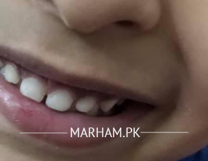 Teeth Discolouration 