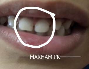 Teeth Discolouration 