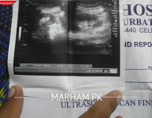 میرے گرد ے میں پھتری ہیں ڈاکٹر مجھے آپریشن کیلئے کہہ رہے