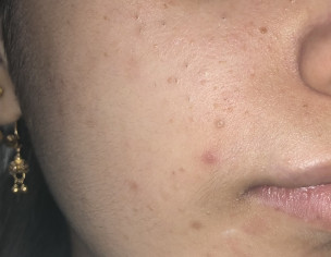 Acne Problem