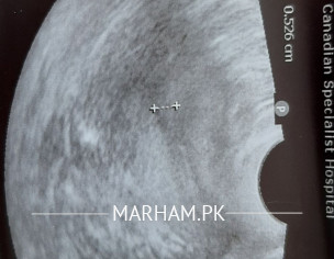 Tvs After Miscarriage DnC.