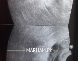 Tvs After Miscarriage DnC.