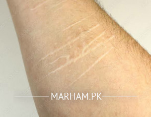 Cut Marks On Arm