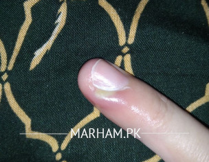 Pus In Finger Nail