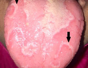 Patches On Tongue
