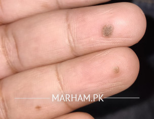 Warts On Finger Tips