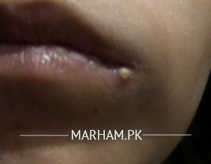 Pus Pimple- Pregnancy 