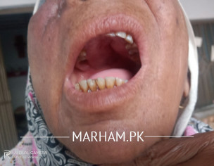 منہ میں فنگل