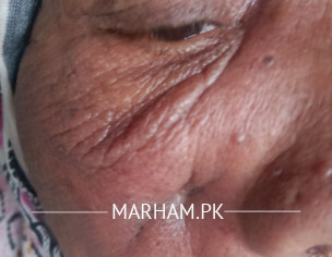 منہ میں فنگل