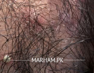 Acne At Back Of Neck