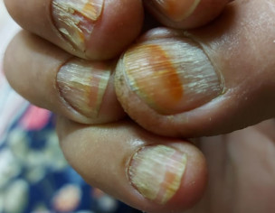 Nail/skin Issue