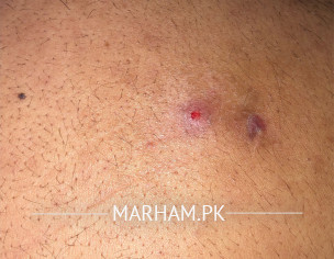 Abscess/MRSA/Carbuncle 