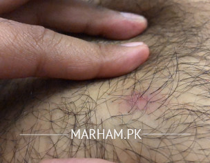 Abscess/MRSA/Carbuncle 