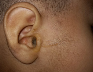 Problem In Ear