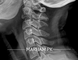 Crawlimg Numbness On Head And Forhead With Dizzines