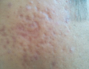 Skin Acne