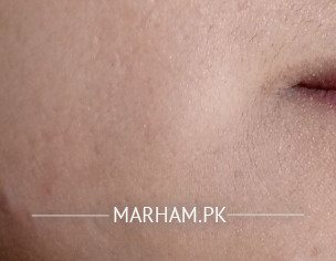 Question About Vitiligo