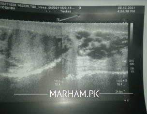 Abnormal Testes Size