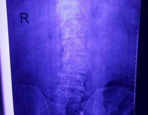 Spinal Disc Prolapse