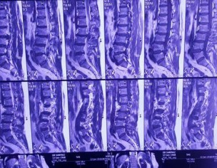 Spinal Disc Prolapse