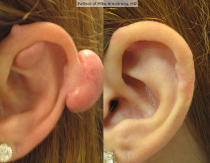 Keloid Behind Ear Piercing