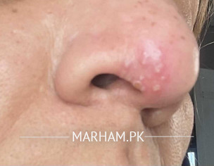 Sore Nose With Blister 