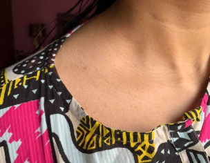 Texture / Dark Lines On Neck
