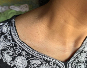 Texture / Dark Lines On Neck