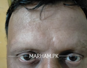 Hair Fall (ball Khor)