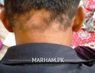 Hair Fall (ball Khor)