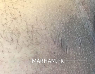 Skin Temperature And Burns 