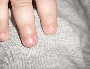 Nail Issue