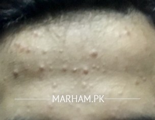 Acne On Forehead