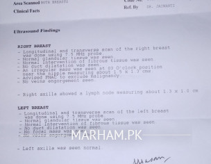 Breast Irregular Mass