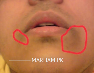 Mark On Face