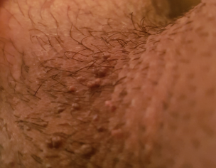Tiny Bump On Penile Shaft