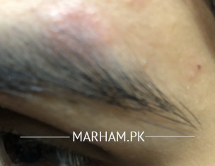 Itchy Patch On Eyebrow-pregnancy 