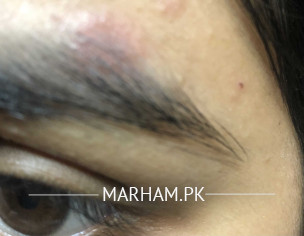 Itchy Patch On Eyebrow-pregnancy 