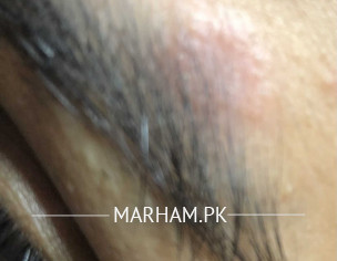 Itchy Patch On Eyebrow-pregnancy 