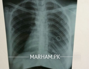 Chest X-Ray