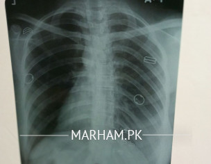 Chest X-Ray