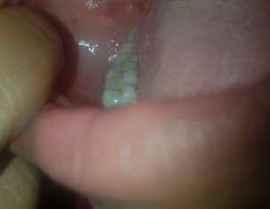 White Patch Inside Mouth